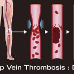 ايجاد لخته در سياهرگ هاي عمقي (DVT) و راه های درمان آن چیست؟ | بیمارستان سیدالشهداء یزد