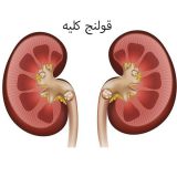 قولنج کلیه ( کولیک کلیوی ) چیست و چه علائمی دارد ؟ | بیمارستان سیدالشهداء یزد