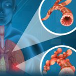 روز جهانی پنومونی (ذات الریه) | بیمارستان سیدالشهداء یزد