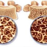 مهار پوکی استخوان با تشخیص به موقع | بیمارستان سیدالشهداء یزد