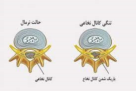 پمفلت تنگي كانال نخاعي | بیمارستان سیدالشهداء یزد