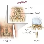 پمفلت آموزشي لامينكتومي | بیمارستان سیدالشهداء یزد