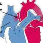 پمفلت آموزشي نقص ديواره بين دهليزها و بطن هاي قلب | بیمارستان سیدالشهداء یزد